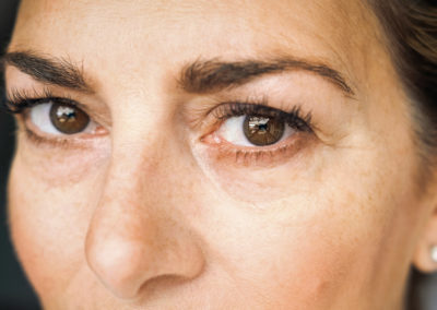 Anti-Aging: Hilfe bei Tränensäcken